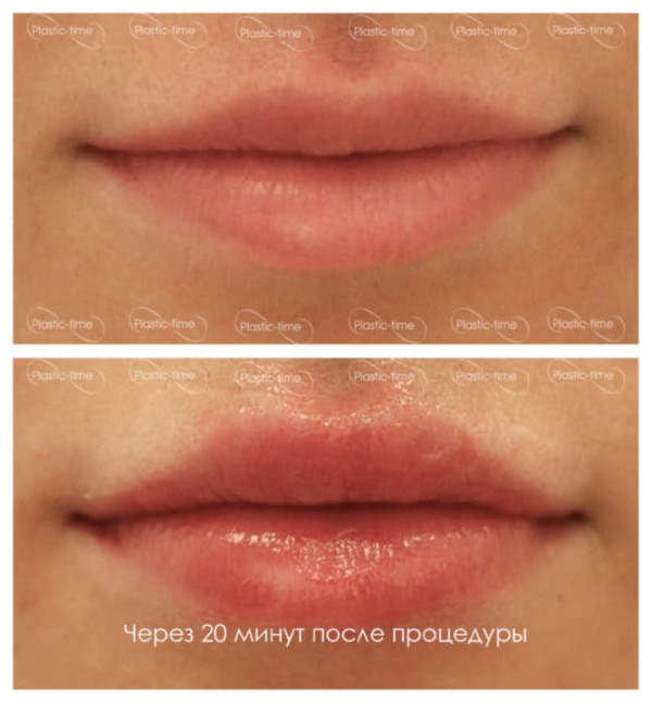 Увеличение губ До и После