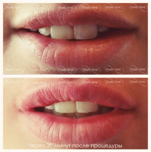 Увеличение губ До и После